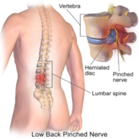 Lumbar Microdiscectomy