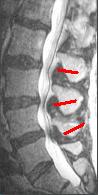 SPINAL_STENOSIS