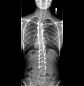 Amanda-Scoliosis_(Post-operative)